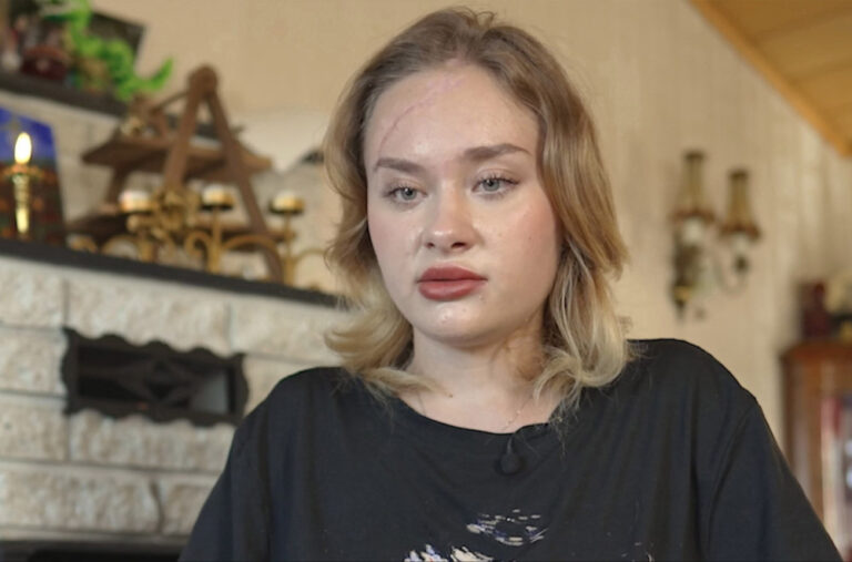 Marija Kovalčuk priznala da je lagala: Nakon što je unakažena u Dubaiju iznela novu priču FOTO