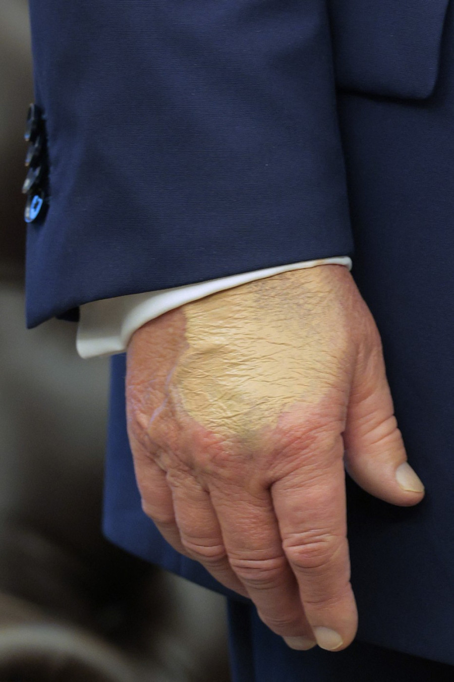 Javnost ponovo zabrinuta zbog Trampa: Viđen sa neobičnim flekama na rukama VIDEO